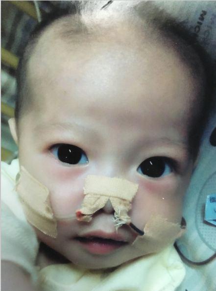 7��29�գ�������ת��㶫ʡ���ױ���Ժ��8��2�պ��Ӿ�������Сʱ�ļ尾���������ڽ����ˣ�����̫С�������������������Ͻ�������֢�໤�ң�ICU����