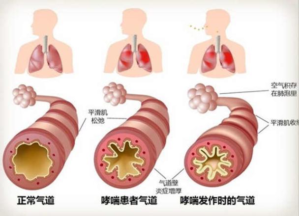 ���������ų��л����̵ļӿ�Ϳ�����Ⱦ�ĳ������أ��й���ͯ�����Ļ����ʲ���������������������ĺ��ӻ���3��ǰ���ַ���֢״���������֮ǰ�����ֻ������������Ƶ��ѶȻ��С�ܶࡣ