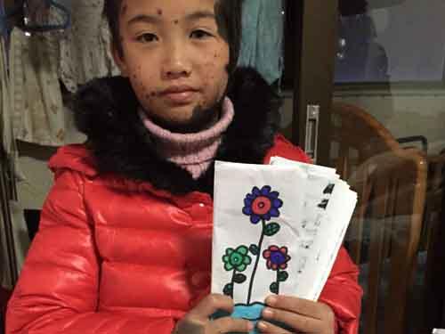 �ٴ�סԺ�󾭹���飬���ϵ�����������Ȼ�����ã����Σ�ֻ������һС�飬�ڶ���ֲƤ����Ҳ��˳�����µ�Ƥ���ܿ�ɻ��ˡ��ְ�ʼ��û�������Ϻ�����������סԺ���������ϵ��˿ڻָ��÷ǳ��ã���ʹ����һ�����������ҽ��˵����������������Ҫ��ʱȥ��ˮ���Ա��ܹ����������������������������