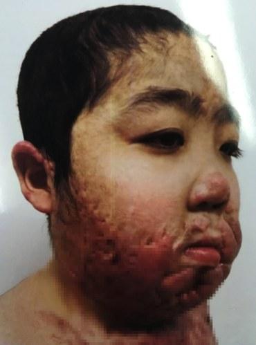 Ŀǰ�����˿�Ȭ���󣬻ؼ��ڼ���Ĩҩ���ơ�û�п���ס���������Ѿ�����Ӱ����֫�幦�ܡ�˧˧��������˫�Ǹ�ũ�񣬱������м׿���������һֱ����ش�ά�����ƣ�����ͻ�����������ѱƵú��ް취��ֻ�ܻؼұ����˼������������Ķ�����