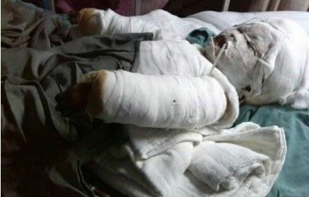 2��14�գ�С���������˽�֫������˫���Ʊ������󴦽ص���ҽ��˵������˫�ִ󲿷�̿������Ⱦ���ٲ���֫��������Σ�ա����������ҽ��ܷ�ס����Ҫ������������Ժ�С��������Ҫ���ܶ��ֲƤ��������������֫����������Ч������ʧ�������˿��۵����ģ�С�������ǿ��֡�