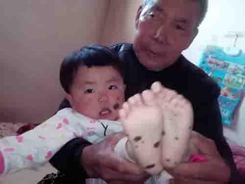 ����һ���У��߷�������С˼�޲��ϵı����ڸ���ҽԺ֮�У�2016��3��28�գ���С˼��ȥ�վ�����ҽѧ�о�������ҽԺ̥�ǰ̺����Ľ����˼�飬��ҽԺ����άƤ����̬��ⱨ������ʾĿǰ�Ĳ��飺��Ƥ��ɼ���ɫ��ĸϸ�����޴��ɫ��С��ϸ���������ԣ��������KJ�Ʒ����ȥ��ɫ�ء�