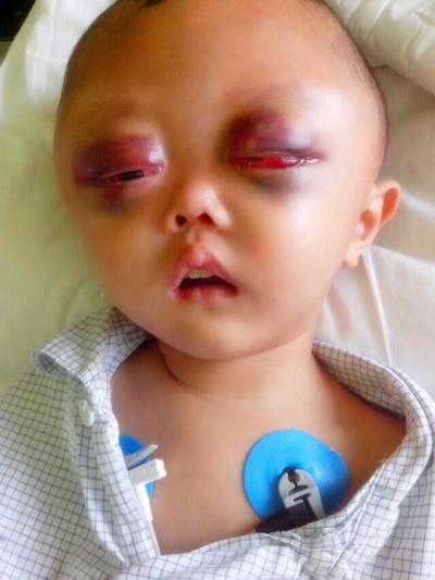 ���ƿ�ʼ�󣬺��ӵķ�Ӧ�ܴ������ʱ��͵�����һ��С��ͷ��Ż�¡��Բ��·�������28��û���´���û�н�ʳ������Ӫ��Һά�֡����������Ƴ��޹���ҽԺҲ���²�Σ֪ͨ����������������׼��������������ô���ܷ�����