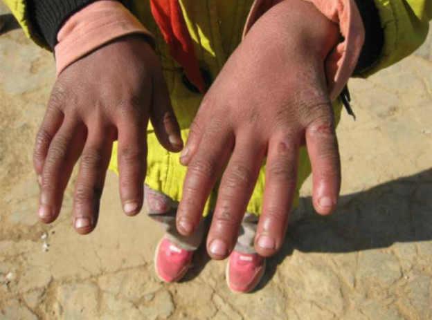 ȥ��ɽ���ᷢ�����ǵ�С�ֺ����϶������ú����˵ģ�ÿ�����죬���������������벻�˵�Ӳ�ˣ�������Щ���ѵĿ��ӣ�����Ҳ����᲻��������ʹ�ͷ����ĸо�����Ϊ�������˿��Լ��·������ǿ��������ס�ñ�ӡ�Χ������ʹ�������ˣ�����Ҳ�и���ҽҩ���������ǵֵ���ʹ��������Щ���Ƕ�û�У�