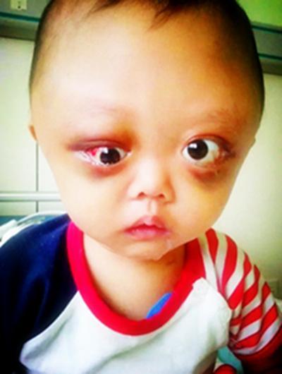 2014��4�µף����ӳ������գ�����Ϊ����ͨ�ĸ�ð����һֱ���롢��ҩ����������ת����������һ�������ڣ�����ÿ����֣���Ը�µ���·����������ȥ���Ŷ�Ժ��飬��鱨����ʾ����Ϊͷ�������������Ӵ˺���һ��һ������̫��Ѩ�������������۾���͹����Ƥ��������˺�ɫ���������Ҳ�ر�