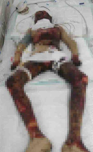 &ldquo;ҽ�����߿��񻪣����´����˳̶ȷǳ����أ�һֱҪ����ס��ICU�����������ڶ�û������Σ���ڡ�&rdquo;����Ŀǰ���������Ʒ����Ѿ���ȥ2����Ԫ��ҽ����ʾ�������Ʒ��÷ǳ��ߣ�������Ҫ30��Ԫ�����������ػ���ת�������ҽԺ�������ơ�&ldquo;ҽԺ���������д�ţ����´�����������ﵽ��80%��&rdquo;