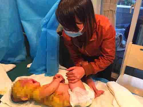  ������������Сʥ���������µ���ˣʱ����С�������˿�ˮ������ʹ����ͷ���������ˣ�Ƥ�����䣬�����漴���˴�Ƭ��ˮ�ݣ�һ���˱��ź��ӸϽ����ٸ���ҽԺ�ϣ����������ҽԺ��ҽ���������ǣ����ӵ����˱Ƚ����أ��������ǸϽ�ת���������ơ�