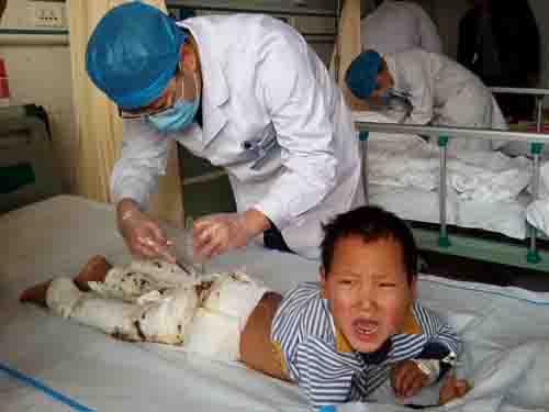 2016��3��10��һ�磬�����С��������Ūʪ���·�������˯����С���С�İѱ��Ӹ��ŵ��������ص�¯���ϣ��������������ӵļ�������ѷ��ֱ����ű����Ѿ��Ѻ��������ˣ����Ѻ��Ӵӻ��оȳ�ʱ�����ӵ��������ǽ���һƬ�������˵İ����£�С������͵�����������ҽԺ���ơ�