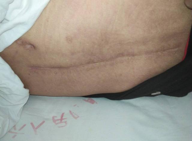 ��û�뵽��©ƫ�������꣬��Ϊ���ж������ĸ�����2013�껼���صĹǽ�˺ͷν����������࣬�Ⱥ�������֣���е�������ҽԺ���ƣ���������������16��Ԫ������9�¸��׸о����۲����з���֢״������ǮסԺ�ڼ���Һ20���첻����ת��10��8�յ�֣������ҽԺ����飬���ֲ�����ء�