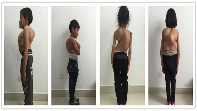 �������仼�ߵļ������ڷ���������ԭ���¼���ʧȥ����������������ֱ�ӵ�Ӱ����ǶԻ�����۵ĸı䣬�ձ���˫�粻�Գƣ��ȵȡ����Ż���ʱ����ӳ����������γ̶��𽥼��أ��������������񾭵�ѹ�ȣ�����֫����ľ������������̱���������߻�ѹ���ġ��κ͸�ǻ����в���ߵ�������