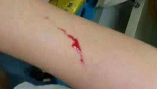 �����Ӱ�ҽԺ��һ����ͮ����������ʿ����ֹ���̲�������ɱ�����У�����ɱ�������˷�����HIVְҵ��¶���¼�������ҽ����ʱ�������˿ڽ��з���Ⱦ���������������ҩ���һ��ʱ��ķ�ҩ�������赼����Ѫ���Ϊ���ԡ�����ͮ���ط�������λ�������Լ��ľٶ���Թ�޻ڣ��������ᶨ��Ŭ�����������ġ�